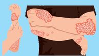 Novi oralni lek protiv psorijaze deluje poput „prekidača“ za upalu: Ko može da ga koristi i koliko čisti kožu
