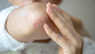 Koža je samo jedan deo priče: Psorijaza može da poveća rizik od drugih ozbiljnih bolesti