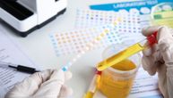 Novi test urina u više od 90 odsto slučajeva prepoznao rak mokraćne bešike