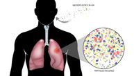 Naučnici došli do zabrinjavajućeg otkrića: Oboleli od raka pluća imaju više mikroplastike u ovom organu