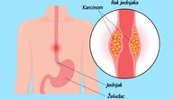 8 prvih simptoma raka jednjaka - tumora koji se češće sreće kod muškaraca