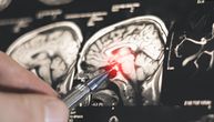 Živela je 15 godina sa epilepsijom, a onda je dobila novu šansu: Tehnologija koja menja pristup lečenju